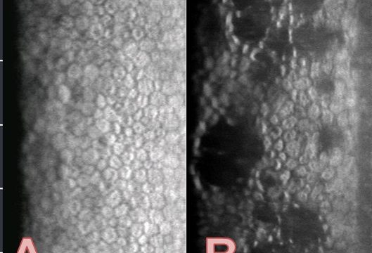 Microscopia Especular da Córnea