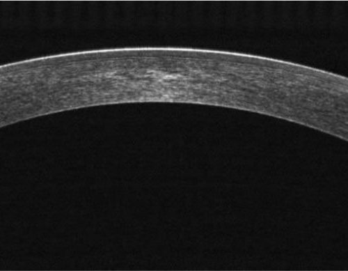 OCT – Avaliação da Córnea